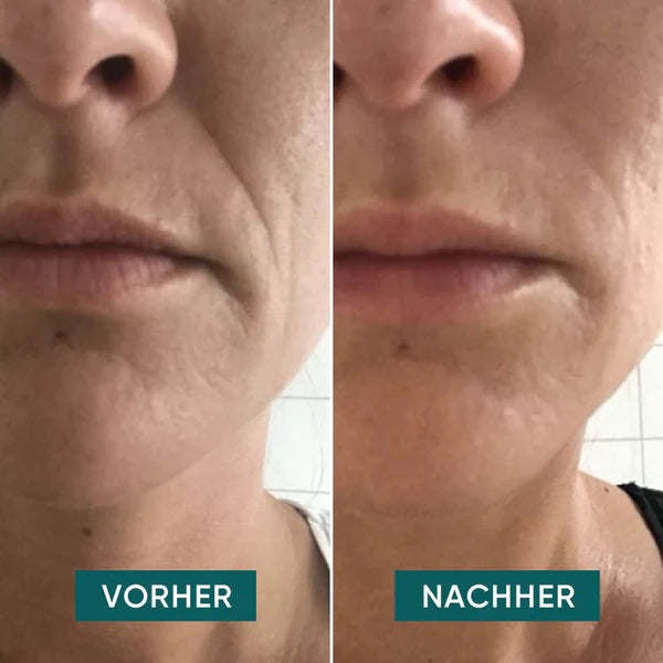 APRICOT - Mund Pads mit Hyaluron