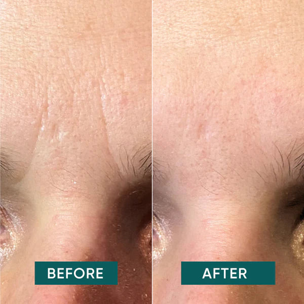 APRICOT Gesicht Patches mit Hyaluron für die Stirnpartie und intensive Feuchtigkeitspflege